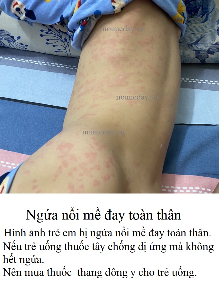 Ngứa nổi mề đay toàn thân